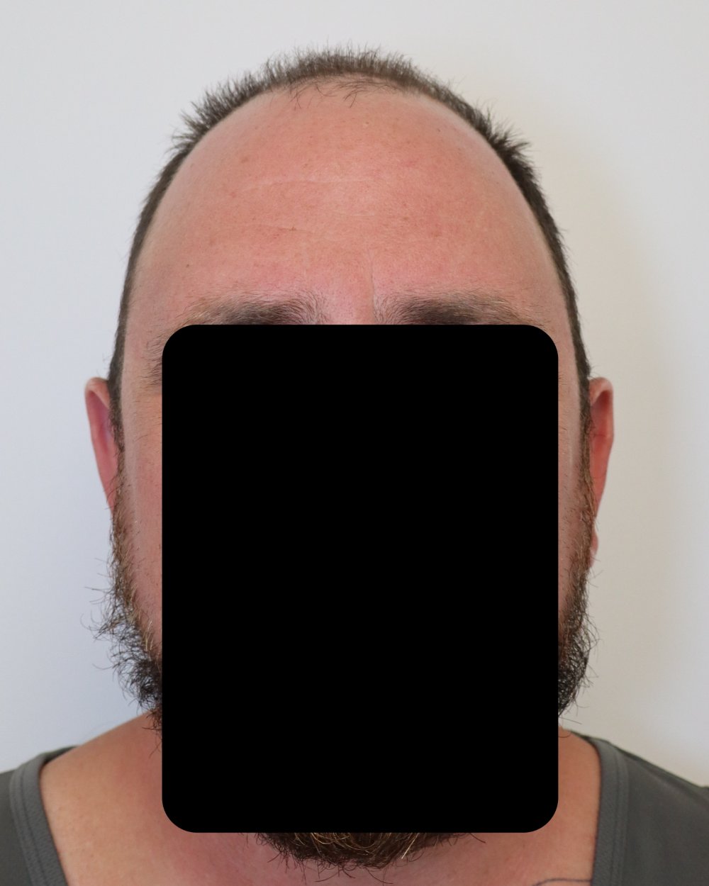 Pre-shave day of surgery