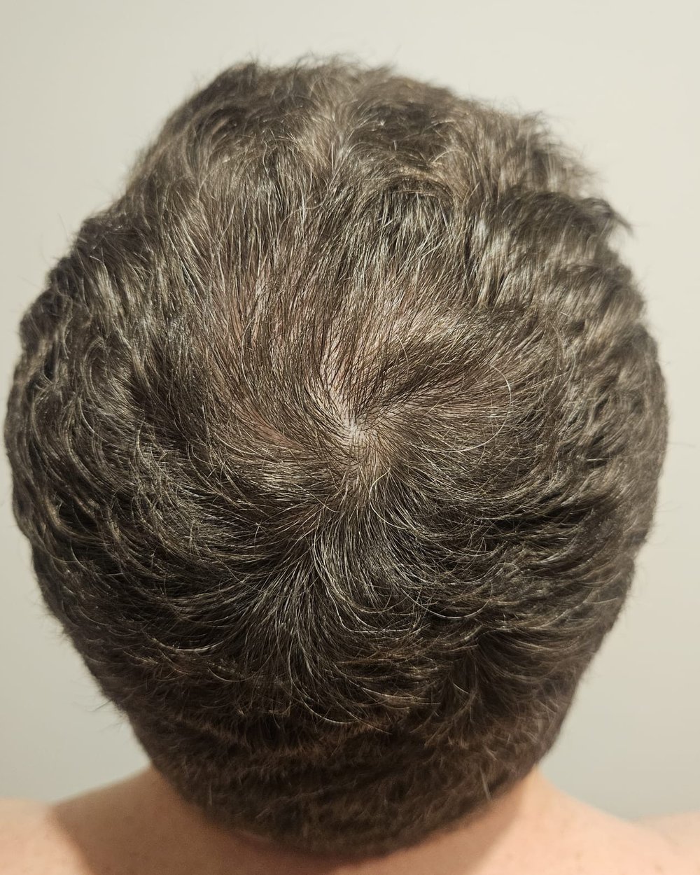 Full restoration 7 months after 3,073-graft FUE hair transplant at Gro Clinics, Auckland