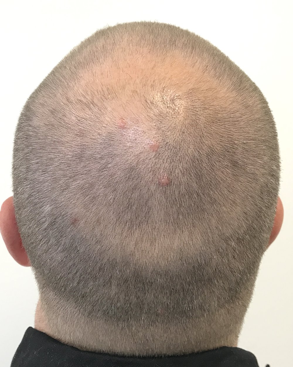 Advanced pattern hair loss before FUE hair transplant
