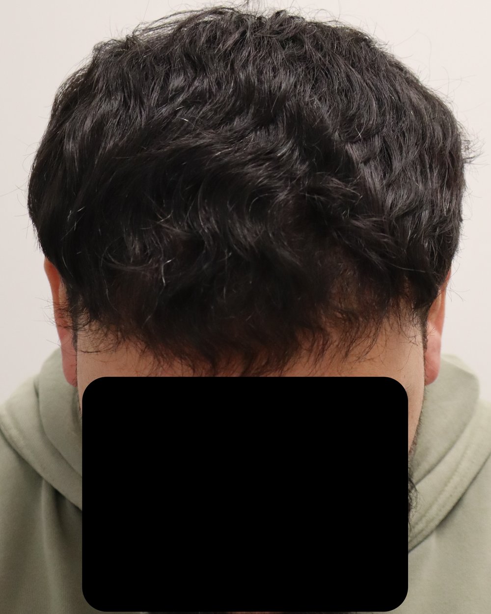 Hairline 6 months after 2,200-graft FUE hair transplant at Gro Clinics