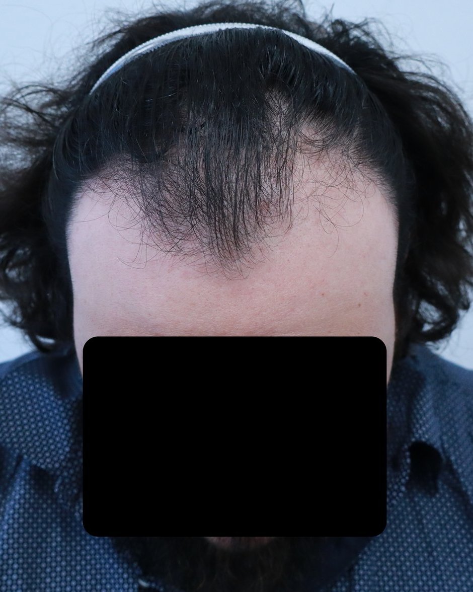 Frontotemporal recession before FUE hair transplant